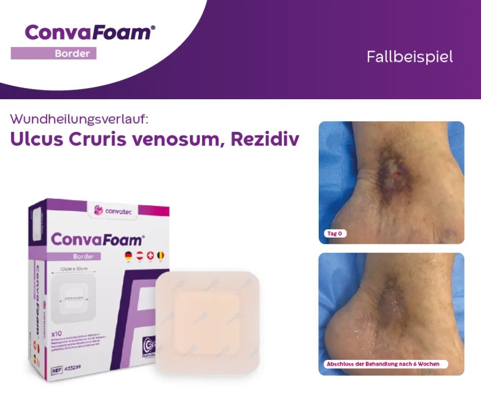 Die Abbildung zeigt den Wundheilungsverlauf eines Ulcus Cruris venosum, Rezidiv und die Verpackung sowie den Wundverband von ConvaFoam® Border.